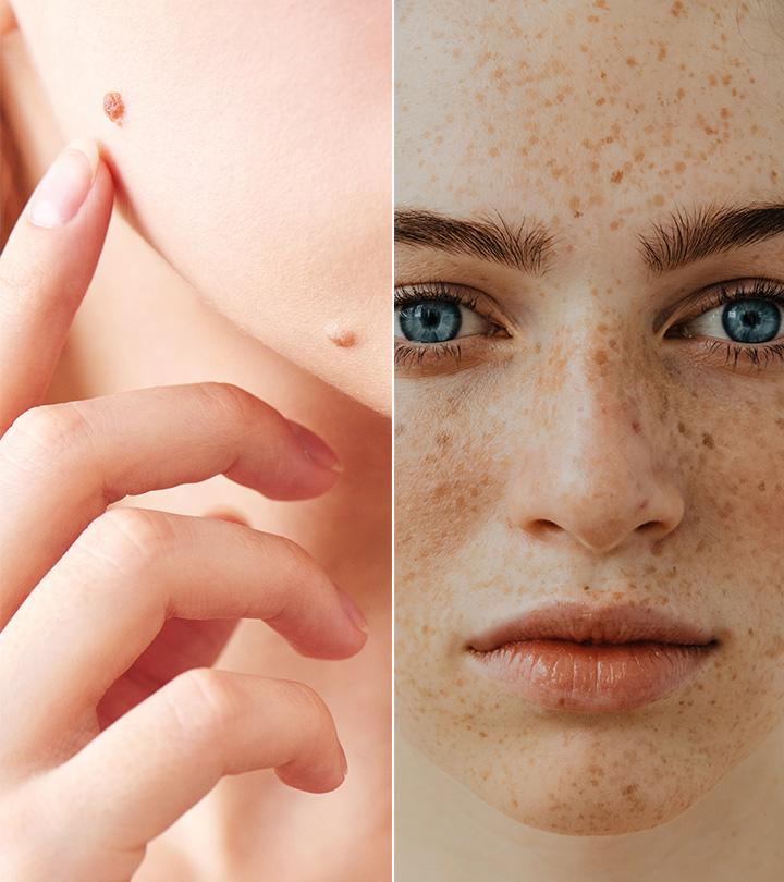 Freckle Vs. Mole What’s The Difference And Is It Dangerous?