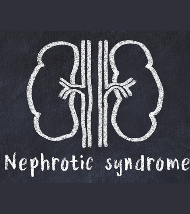 नेफ्रोटिक सिंड्रोम के कारण, लक्षण और इलाज – Nephrotic Syndrome in Hindi