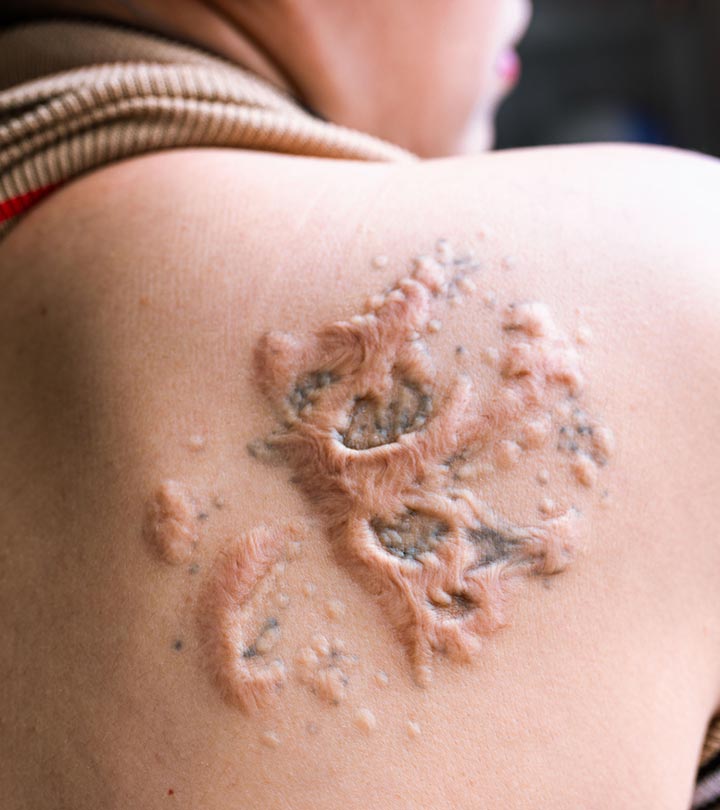 Tattoo Blisters: Causes and Treatment - AuthorityTattoo