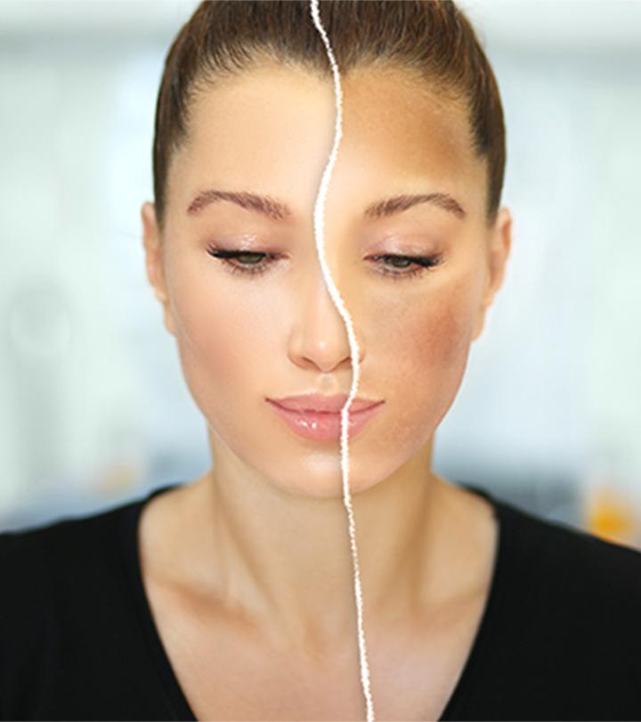 A woman with melasma vs hyperpigmentation