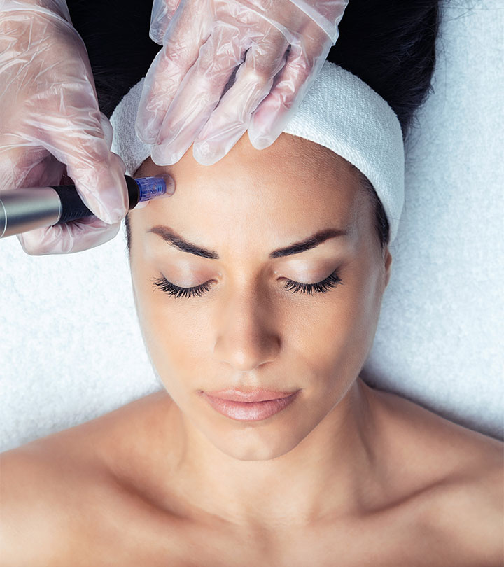 Microneedling For Acne Scars: Benefits & How It Works