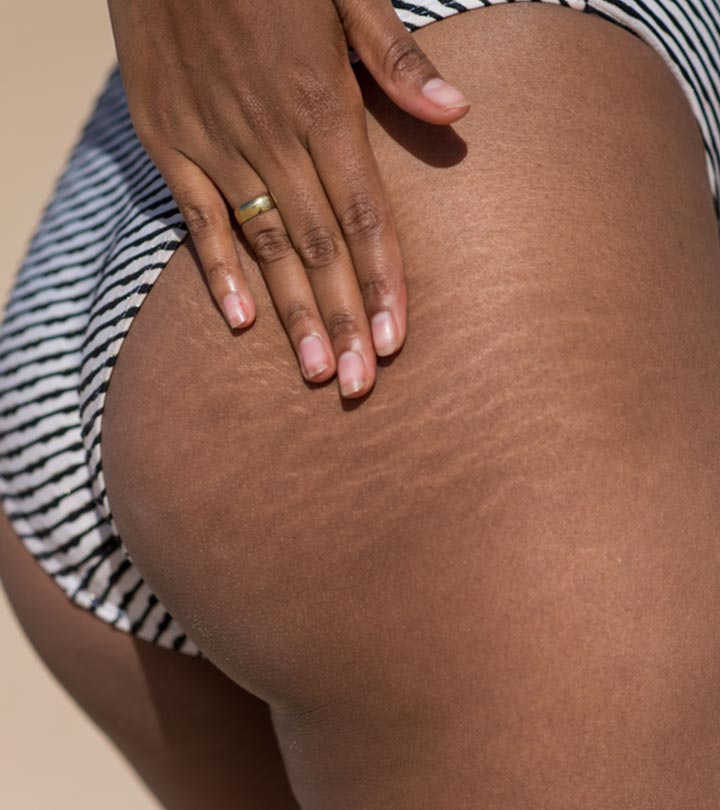 Can You Get Rid Of Stretch Marks On The Butt?