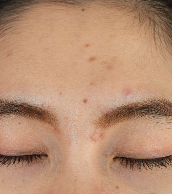 Acne Between Eyebrows: Causes, Treatment, & Prevention Tips