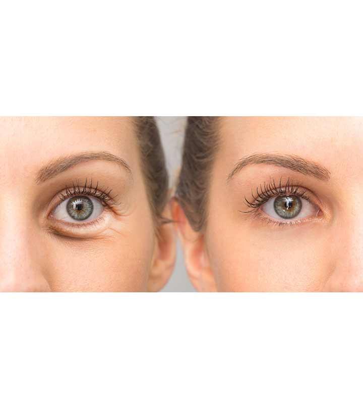 आंखों के नीचे सूजन के कारण, लक्षण और घरेलू इलाज Home remedies For Eye Bags in hindi