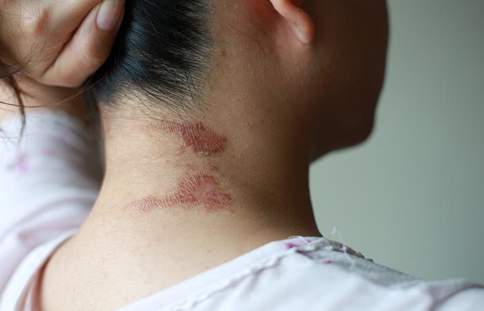 I didn't clean my makeup brushes — it gave me ringworm
