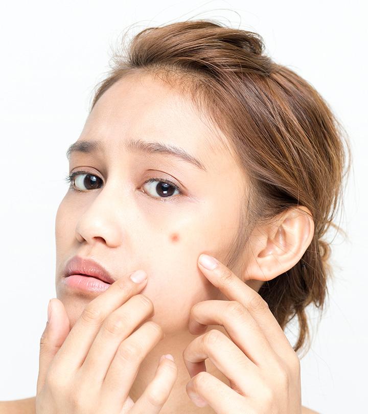 Clindamycin For Acne: How To Use, Benefits, And Side Effects