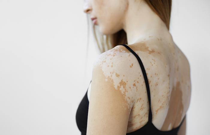 White Spots On Skin: Causes And How To Get Rid of Them
