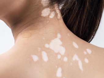 White Spots On Skin: Causes And How To Get Rid of Them