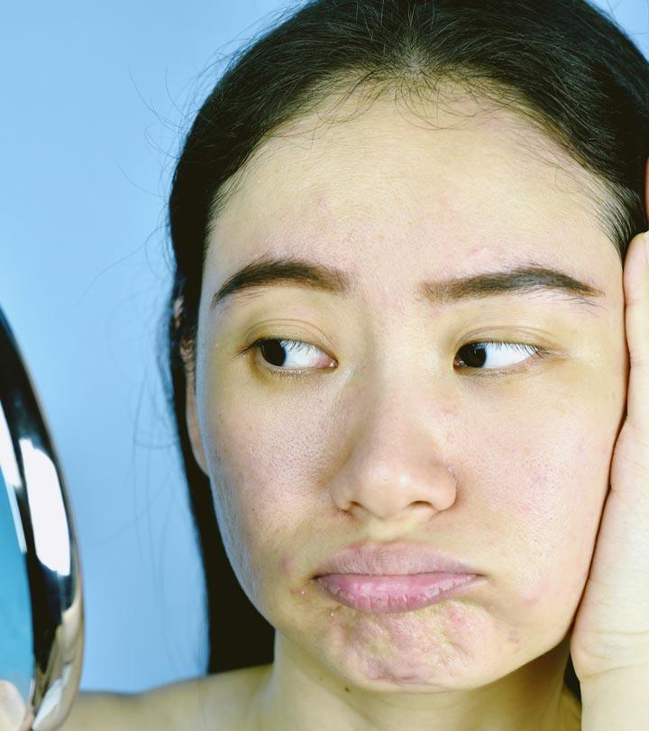 5 Home Remedies For Congested Skin | Symptoms And Treatment