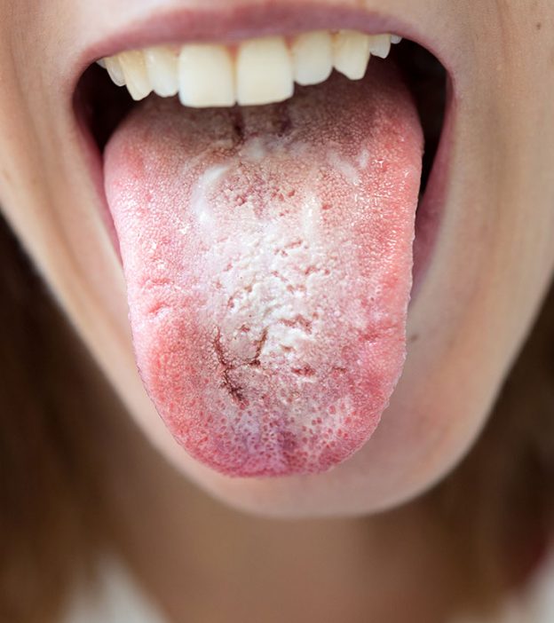 मुंह में फंगल इन्फेक्शन का कारण, लक्षण और घरेलू उपाय – Home Remedies for Oral Thrush in Hindi