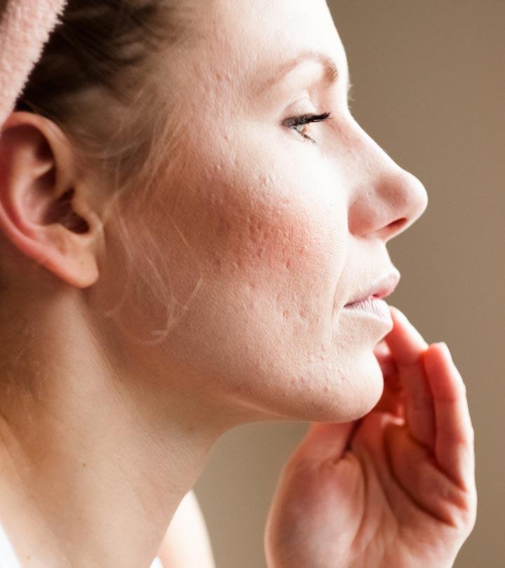 7 Ways To Get Rid Of Pitted Acne Scars