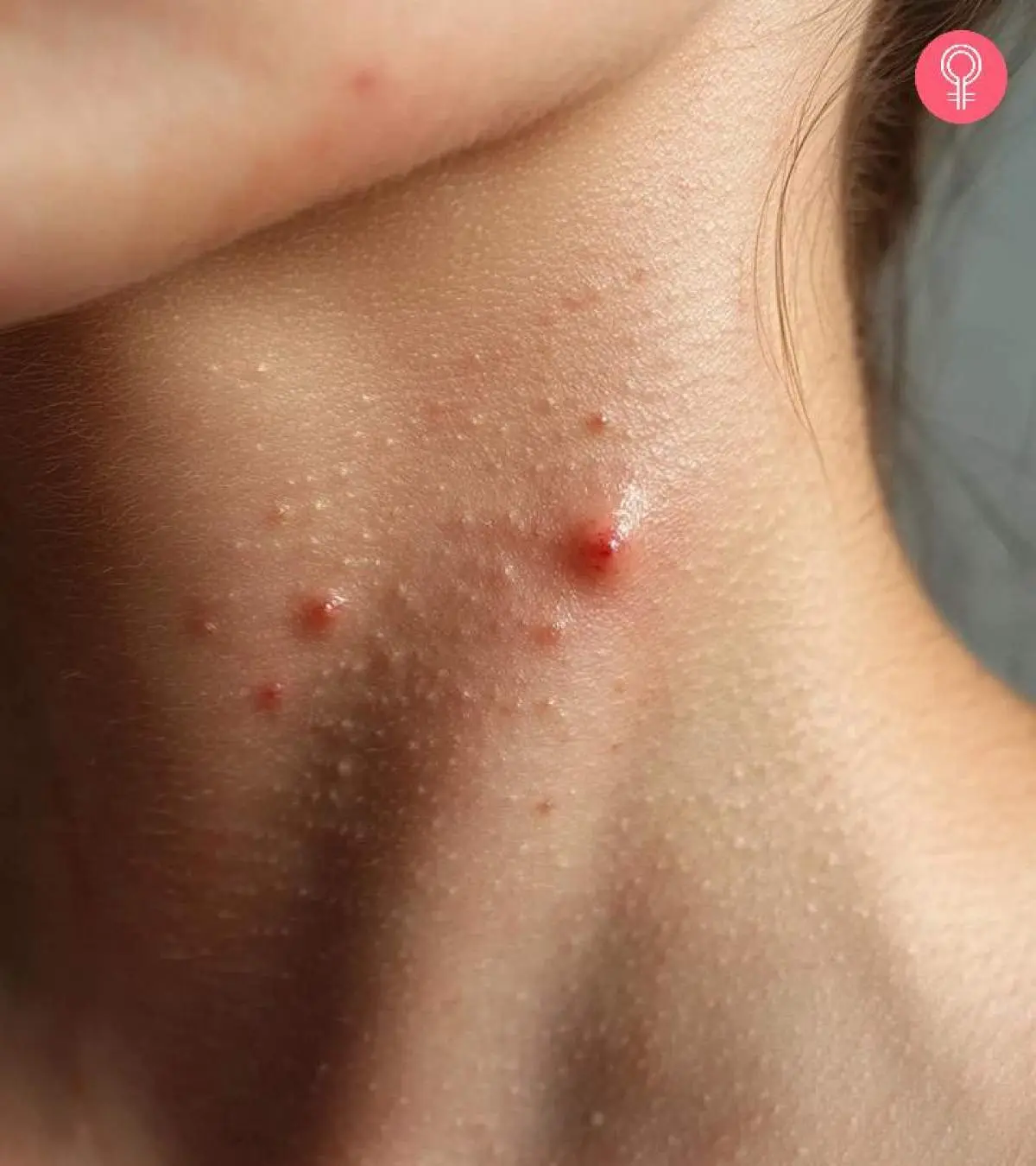 Types Of Neck Acne And Home Remedies For Pimples On The Neck