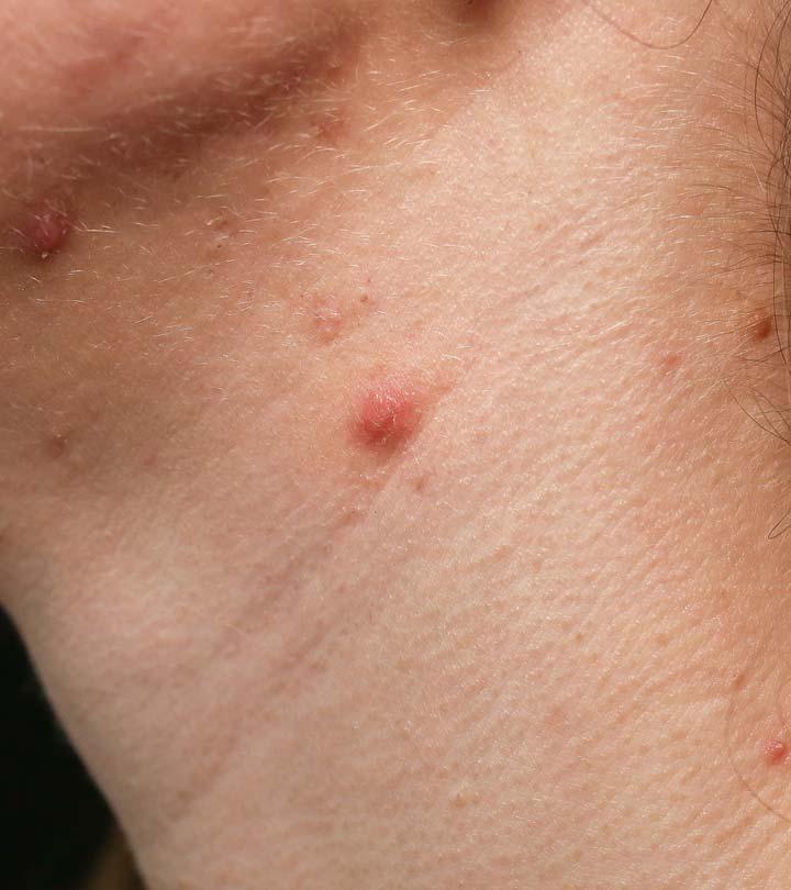Neck acne shop