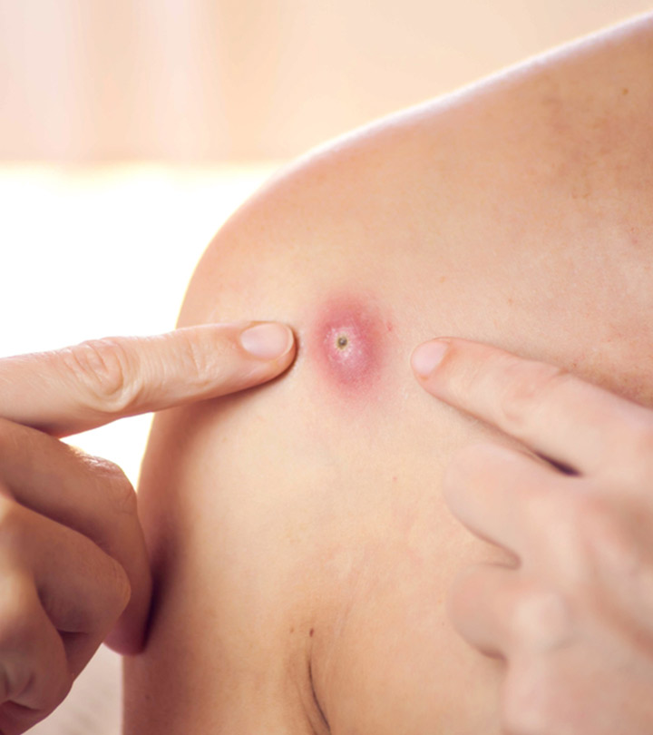 Skin Abscess: Causes, Diagnosis, Treatments, And Prevention