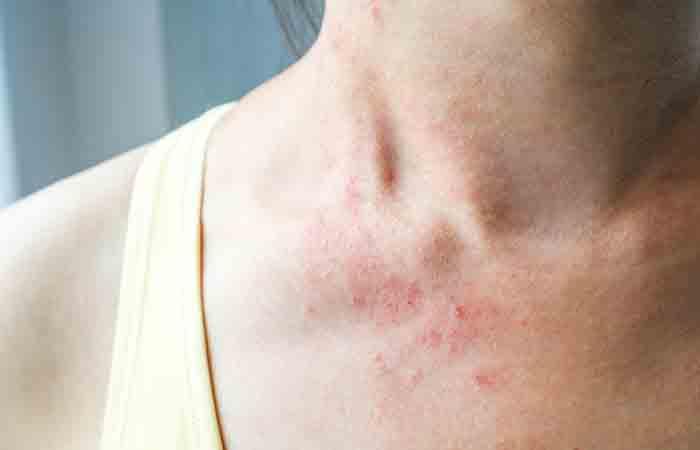 Cat scratch fever: Causes, symptoms, and complications