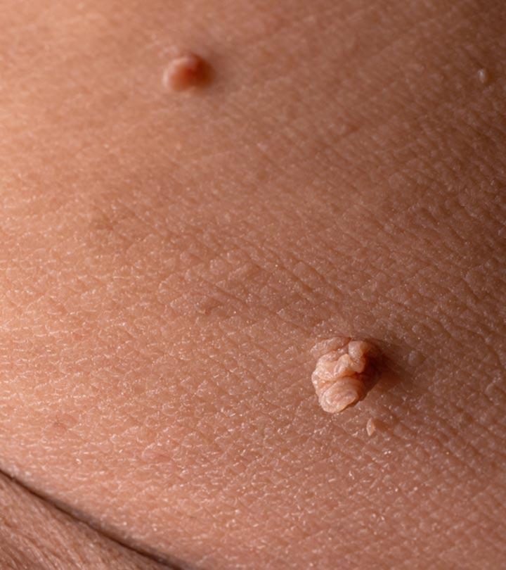 Removing skin tags shop with nail polish