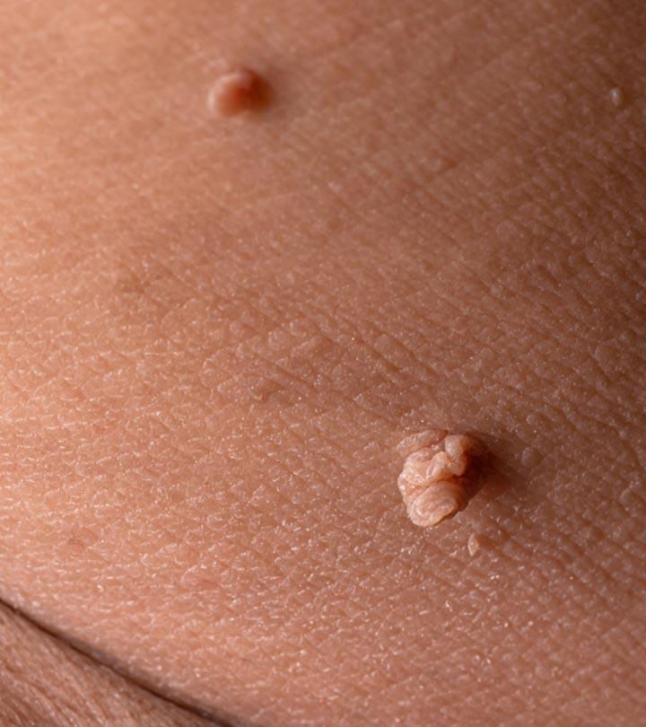 Genital Skin Tags: Symptoms, Causes, Treatment, & Prevention