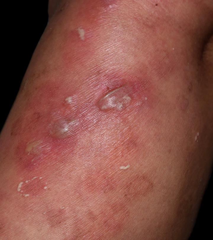 Vesicular Skin Lesions: Causes, Symptoms, Diagnosis, Treatment