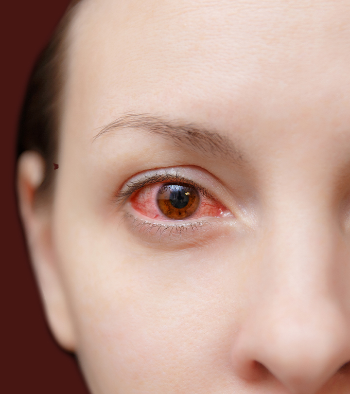 Pink Eye (Conjunctivitis): Causes, Remedies, And Treatment