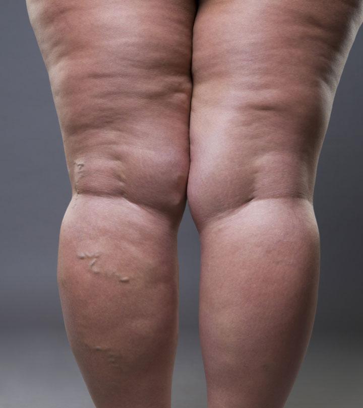 10 Celebrities With Lipedema - Their Stories And Struggles