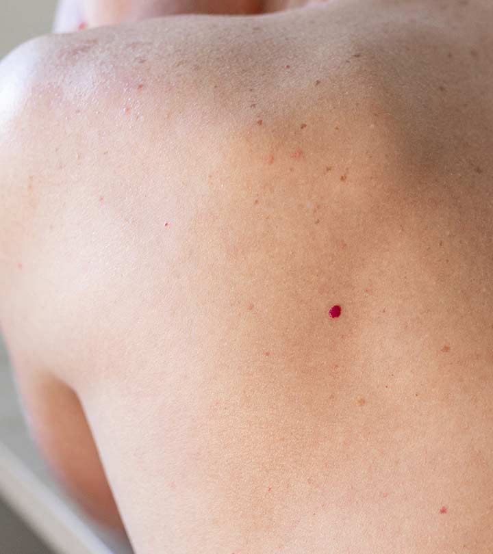 How To Get Rid Of Cherry Angiomas