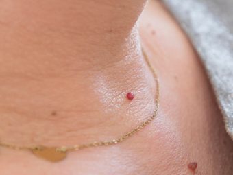 Skin Tags: Causes, Appearance, And Removal