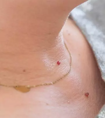 What Causes Skin Tags? How Do You Remove Them?