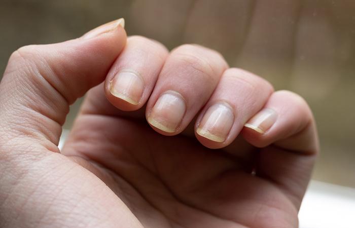 Premium Photo | White spot on the womans fingernail revealed about the  health caused by calcium deficiency