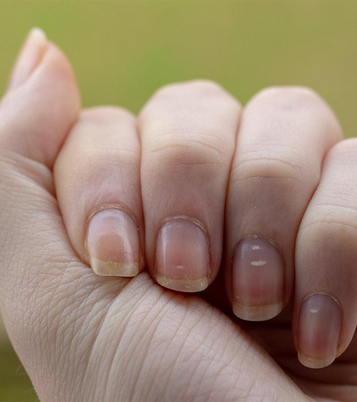 the cause of the white spots on your finger nails