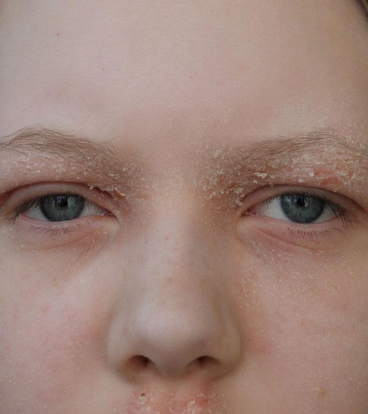 Why Do You Get Dry Eyelids? How To Treat Them?