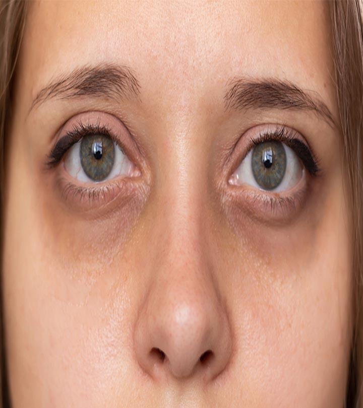 What Causes Dark Circles And How To Treat It