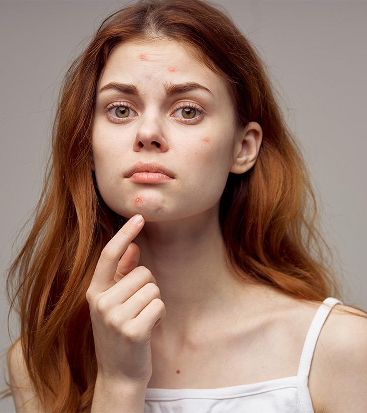 8 Things That Are Causing Acne On Every Part Of Your Face
