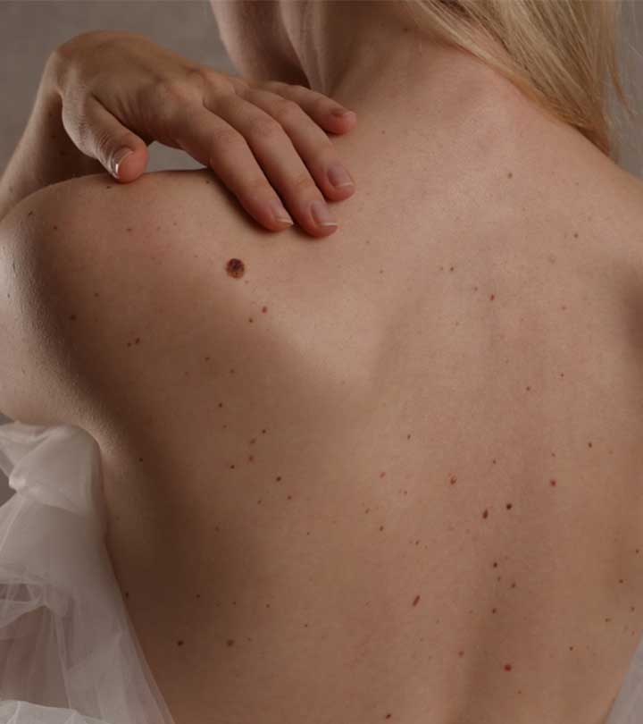 A Guide To Moles, Warts, And Skin Tags