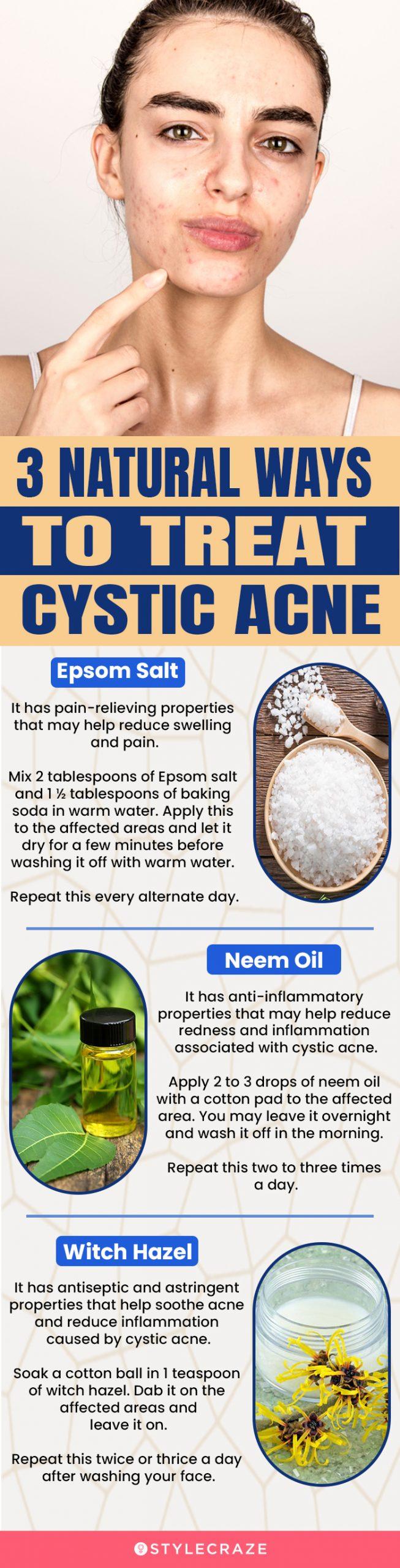 5 Best Home Remes For Cystic Acne