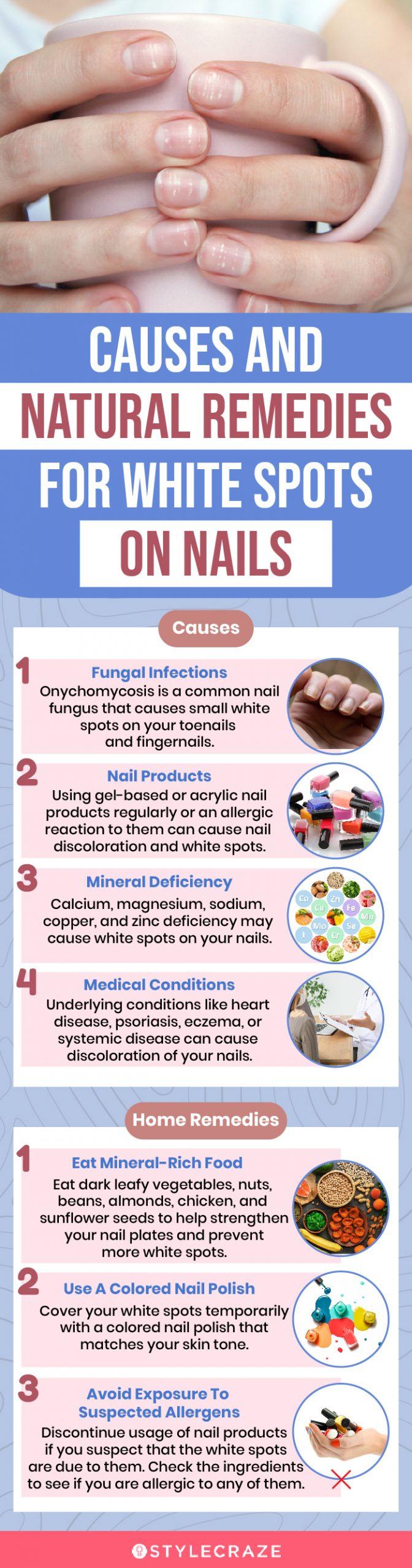 What Causes White Spots on Fingernails? | Wonderopolis