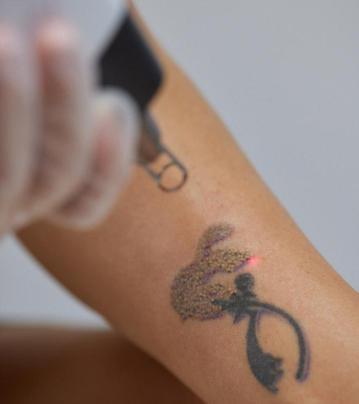 Laser Tattoo Removal How Does It Work And Its Side Effects