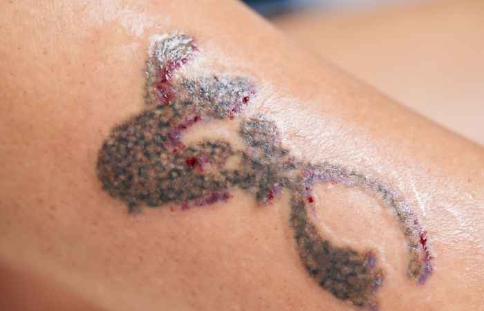 Tattoo Infection: How To Tell if Your New Ink is Infected?