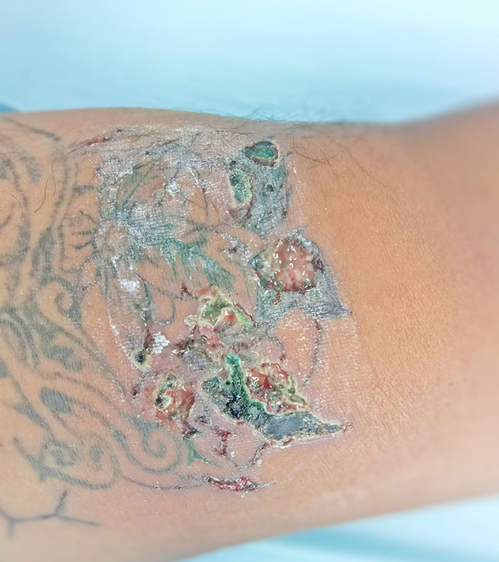 Infected Tattoo: Causes, Stages, & How To Identify It
