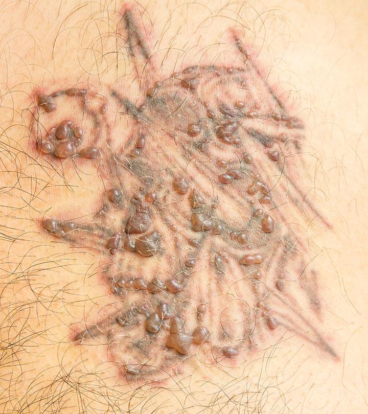 Woman worried about tattoo blisters