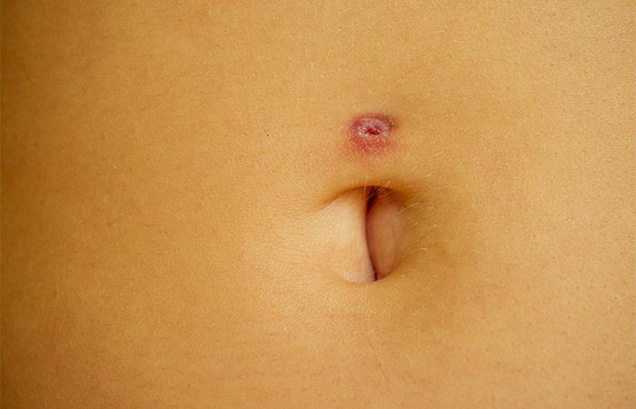 Infected Belly Button Piercing: How to Identify and Treat an Infection