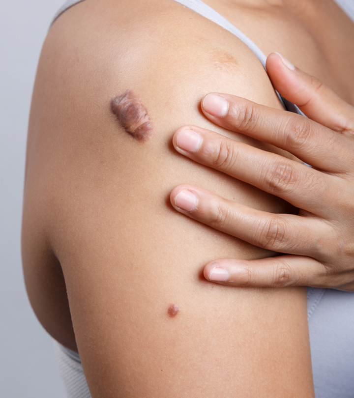 Piercing Bumps Vs. Keloids: Key Differences And Treatment