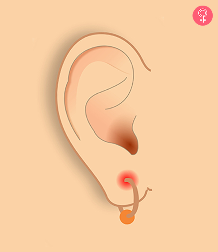 A bump on a woman’s ear piercing