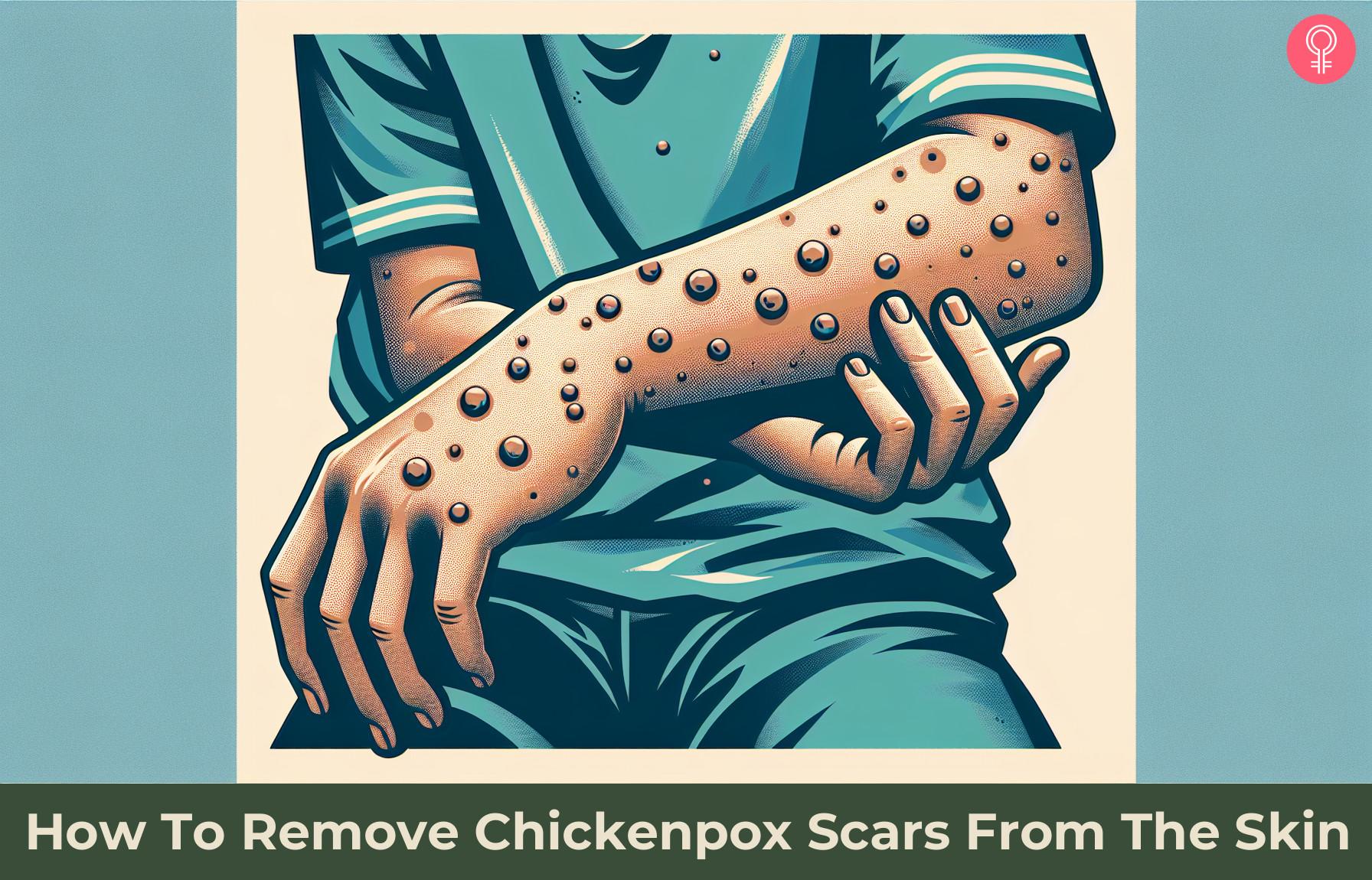 How To Remove Chickenpox Scars From The Skin
